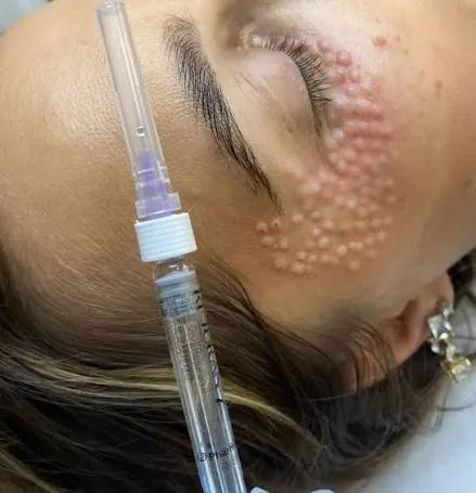 Биоревитализация (премиум: Juvederm/Rejuran)